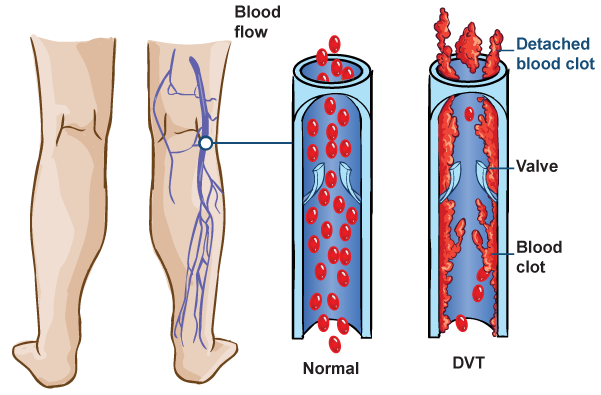 DVT diagram