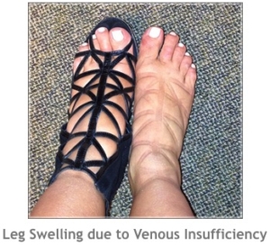 swollen leg and feet