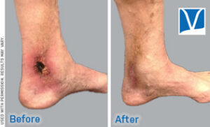 stasis dermatitis before and after