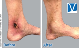 stasis dermatitis before and after