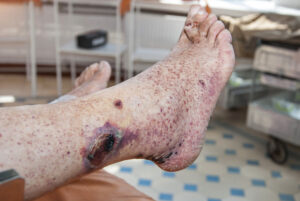 Leg wound and ankle discoloration