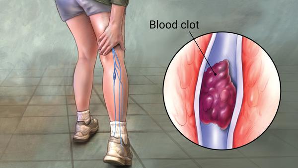 DVT overview blood clot DVT overview blood clot