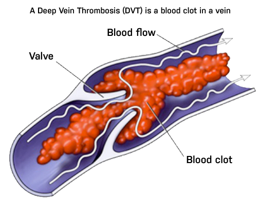 dvt blood clot