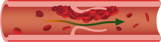 dvt clot illustation